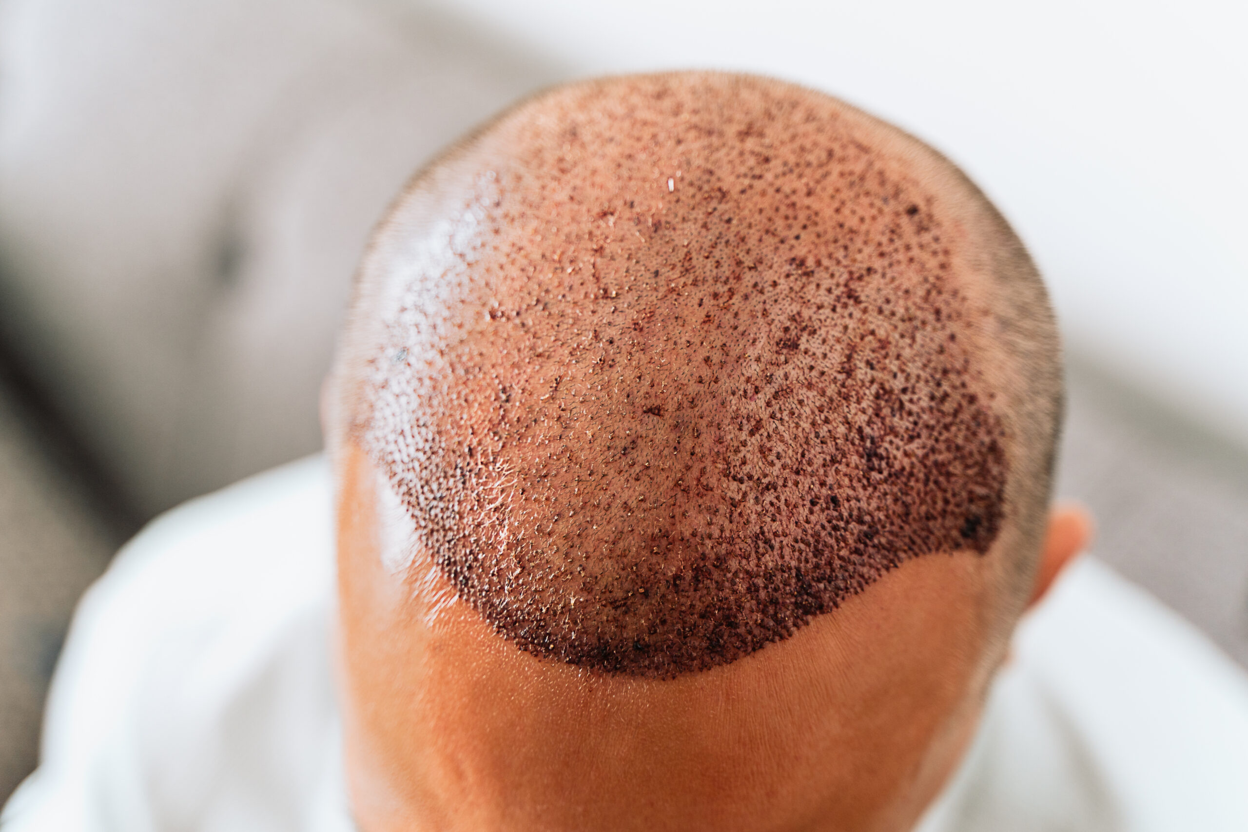 How to Find the Best Hair Transplant Surgeon Near You