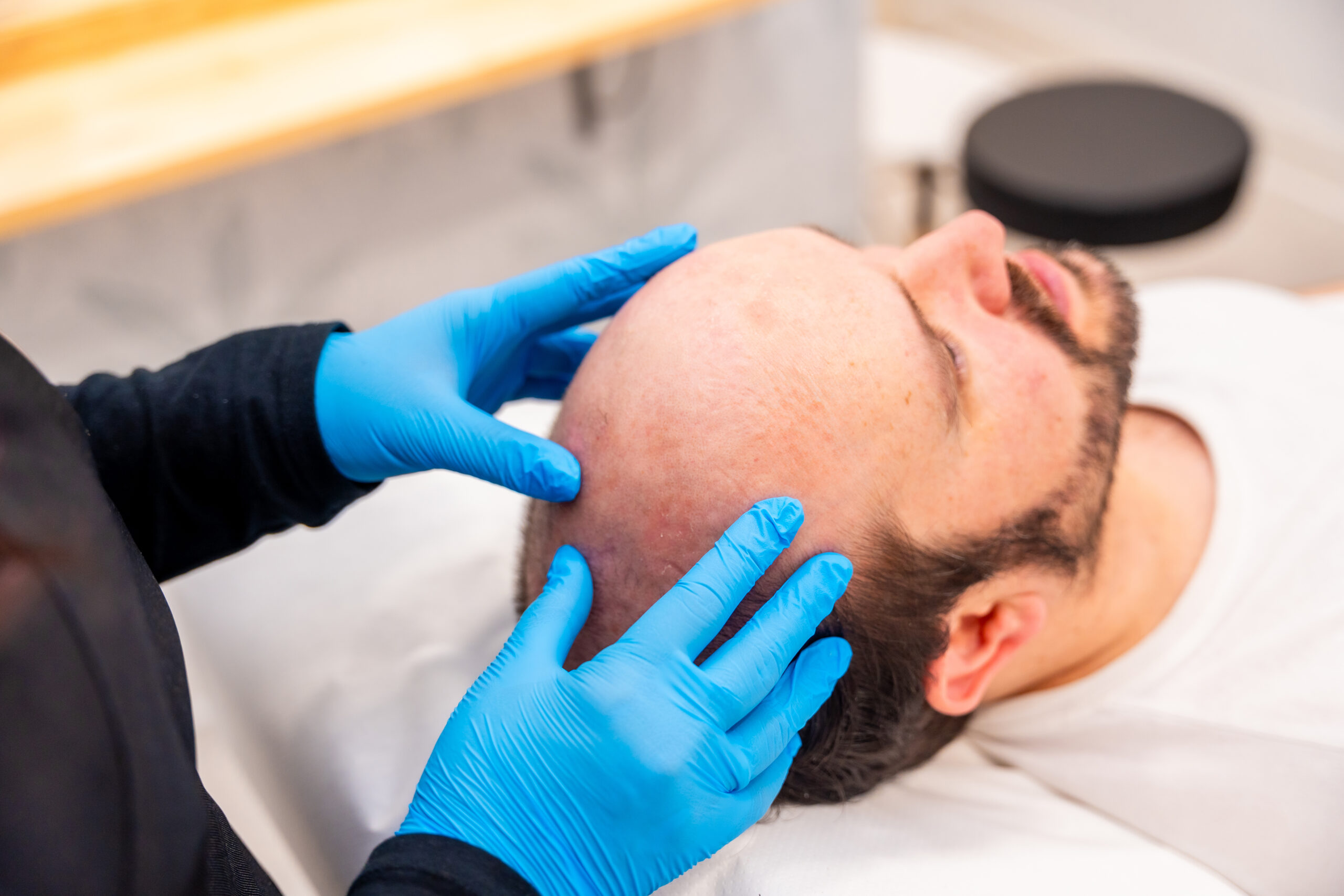 Real Hair Transplant Results: What to Expect Before and After