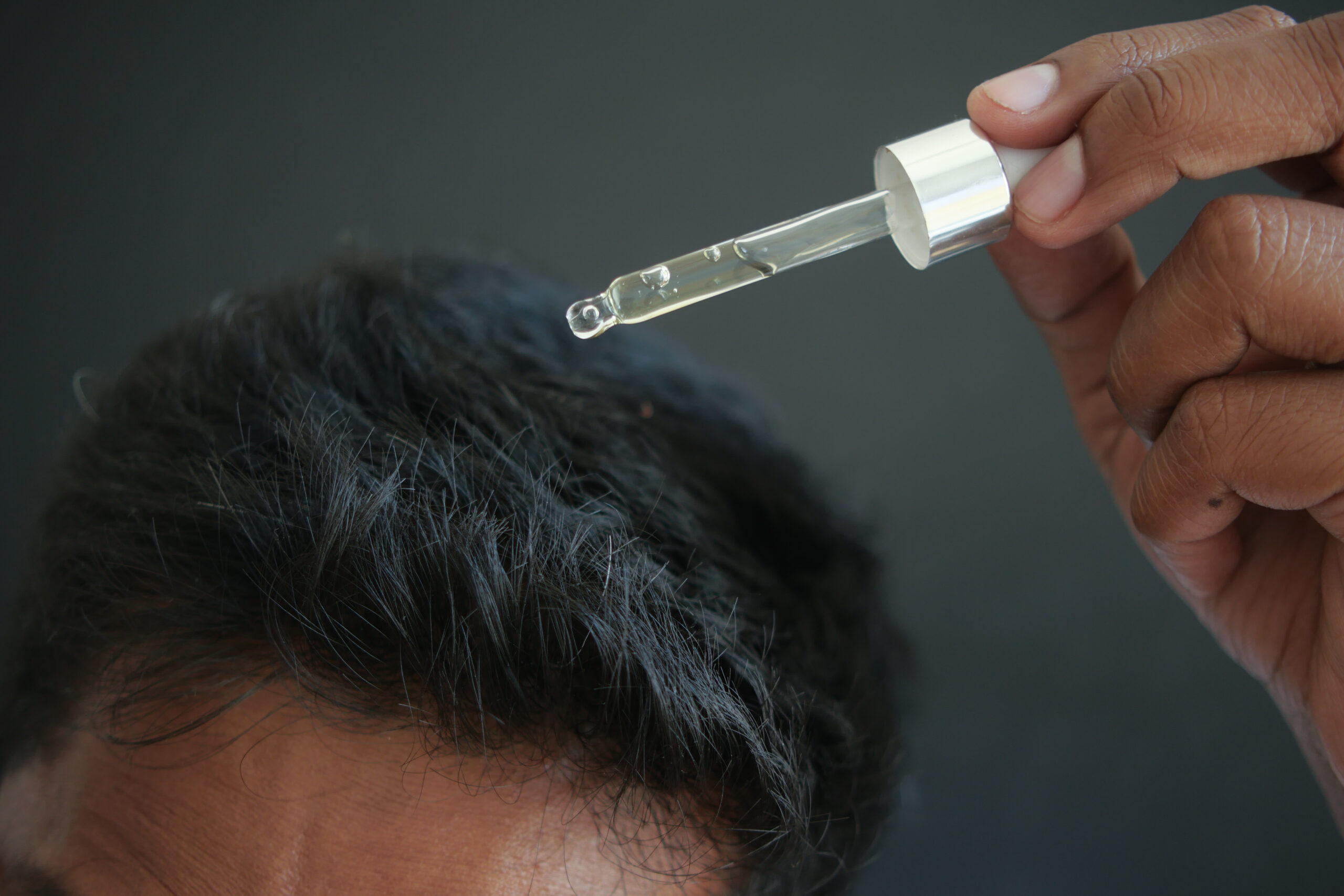 Minoxidil: A Proven Hair Loss Treatment