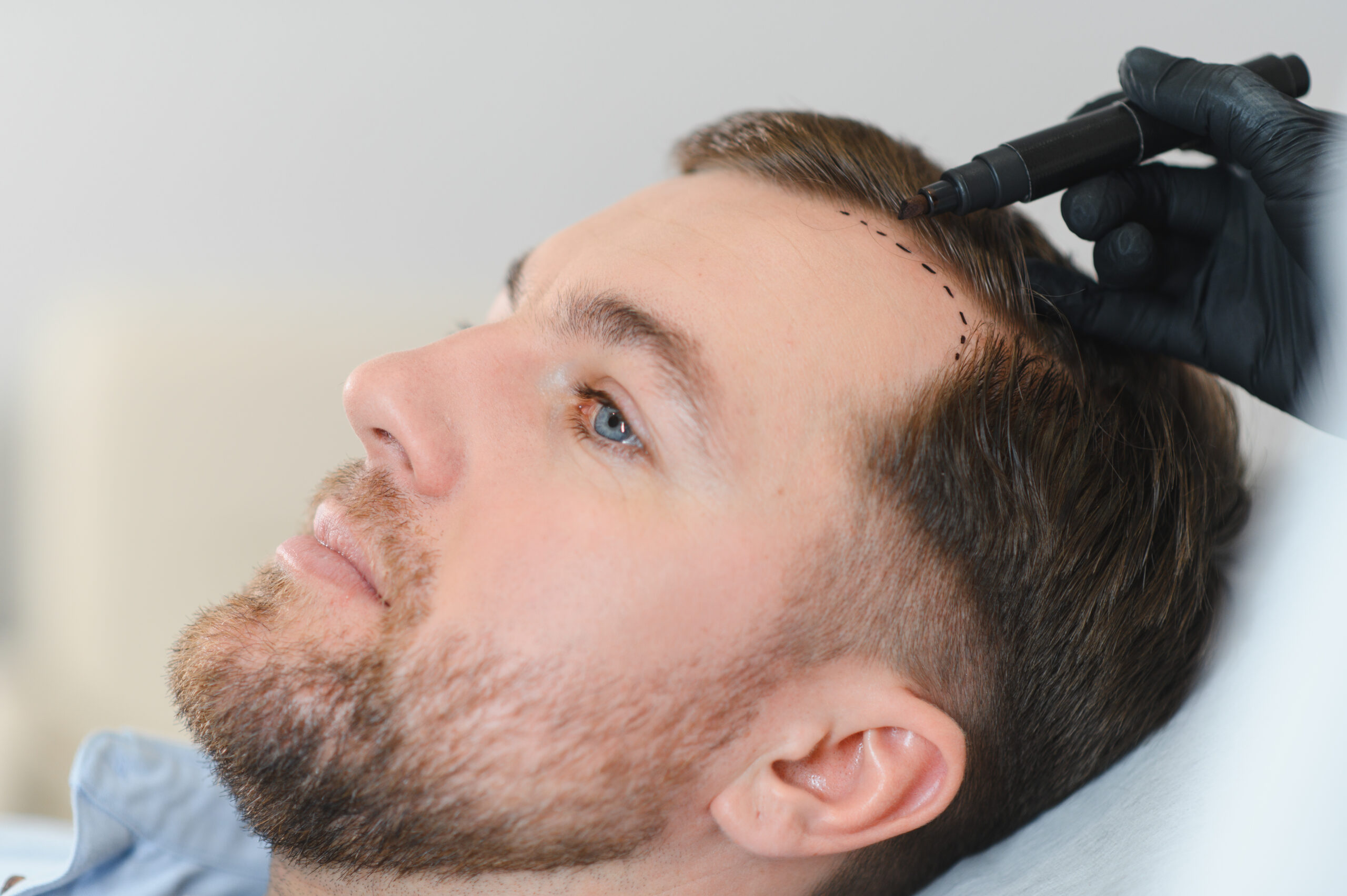 Why Maxim Hair Restoration in Boca Raton is a Win-Win: Hair Transplants and More