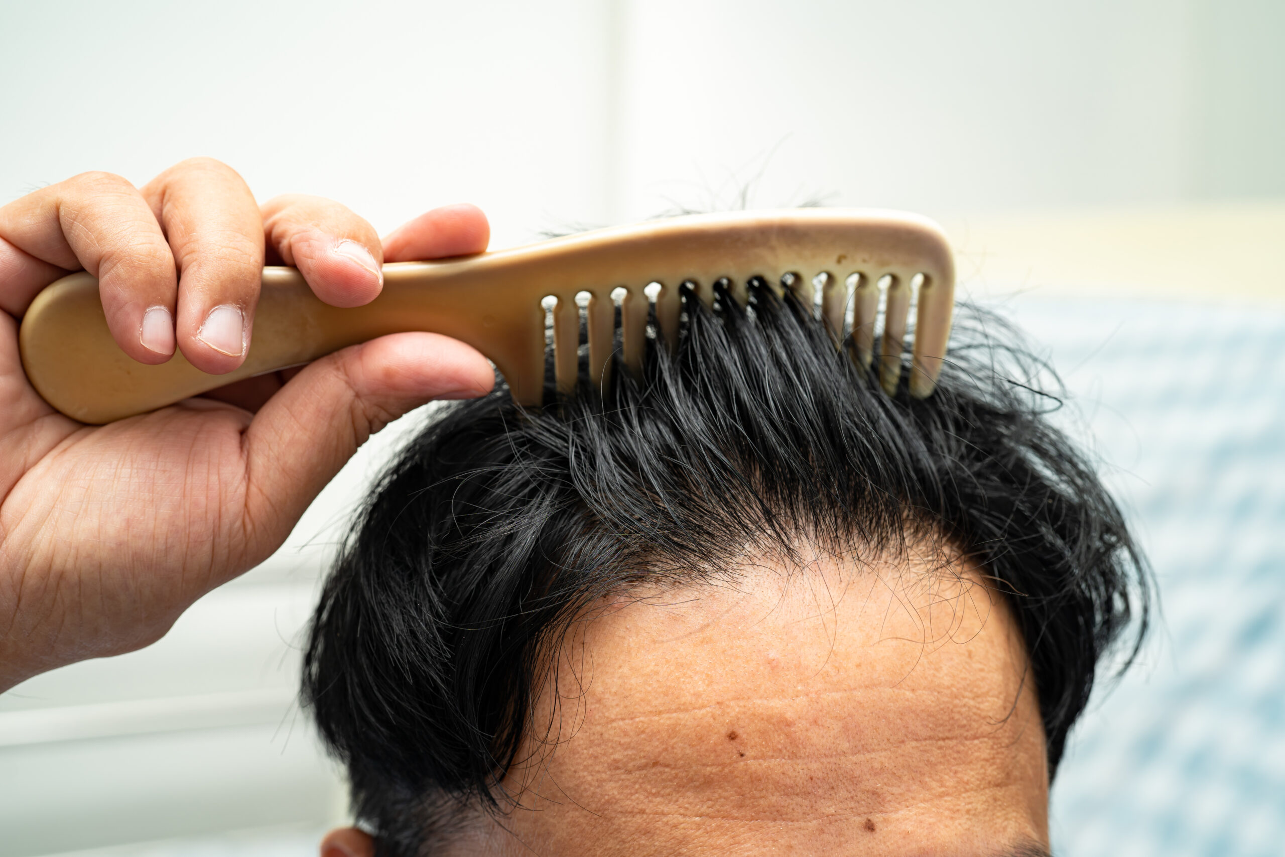 PRP Therapy: Is Platelet-Rich Plasma the Secret to Hair Regrowth?